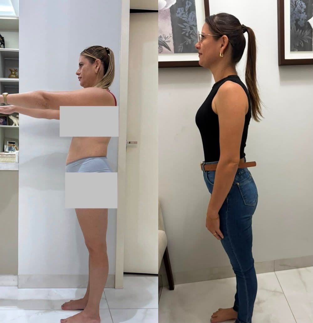 Evolução de paciente acompanhado pelo Dr. Paullineli: antes e depois